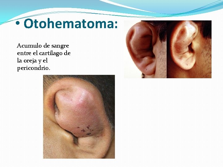  • Otohematoma: Acumulo de sangre entre el cartílago de la oreja y el