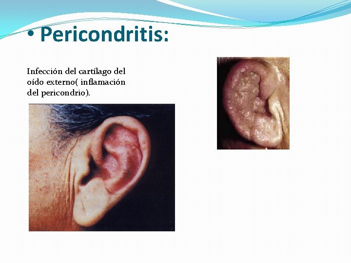  • Pericondritis: Infección del cartílago del oído externo( inflamación del pericondrio). 