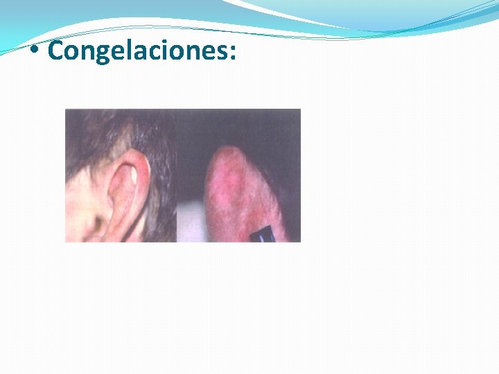  • Congelaciones: 