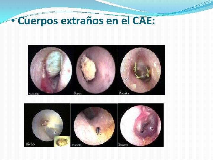  • Cuerpos extraños en el CAE: 