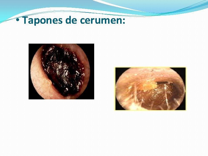  • Tapones de cerumen: 