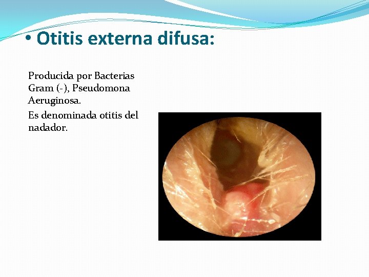  • Otitis externa difusa: Producida por Bacterias Gram (-), Pseudomona Aeruginosa. Es denominada