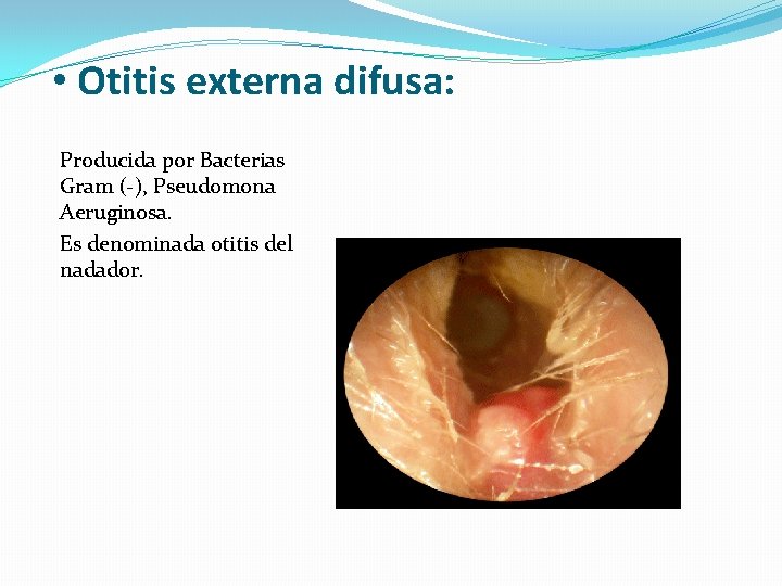  • Otitis externa difusa: Producida por Bacterias Gram (-), Pseudomona Aeruginosa. Es denominada