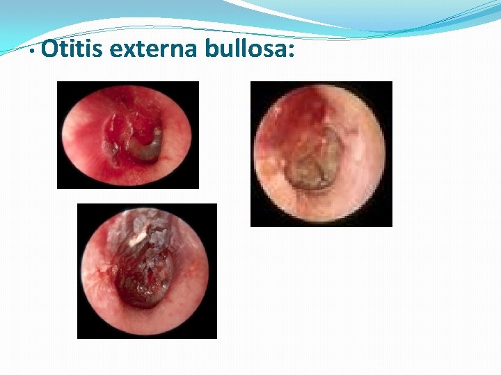  • Otitis externa bullosa: 