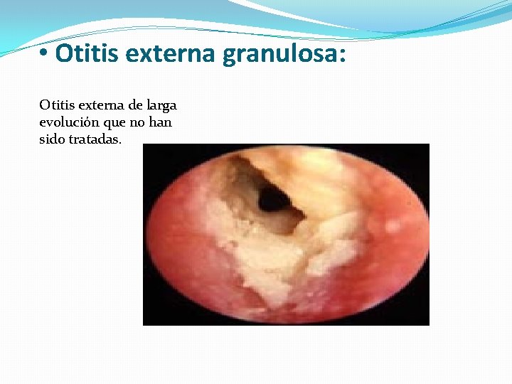  • Otitis externa granulosa: Otitis externa de larga evolución que no han sido