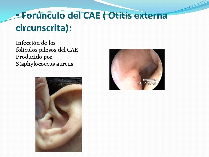  • Forúnculo del CAE ( Otitis externa circunscrita): Infección de los folículos pilosos