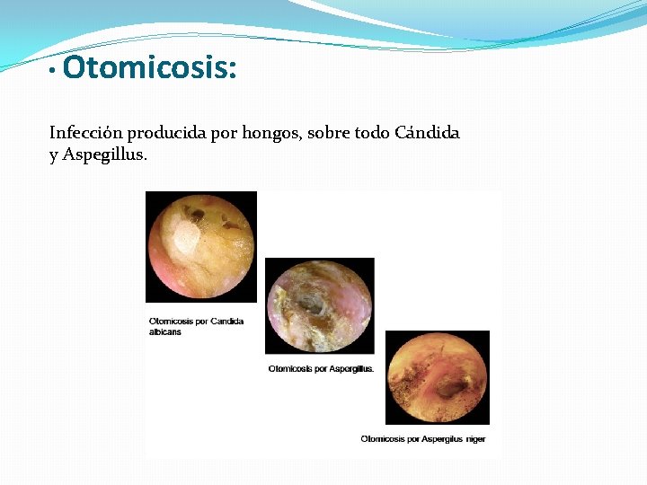  • Otomicosis: Infección producida por hongos, sobre todo Cándida y Aspegillus. 