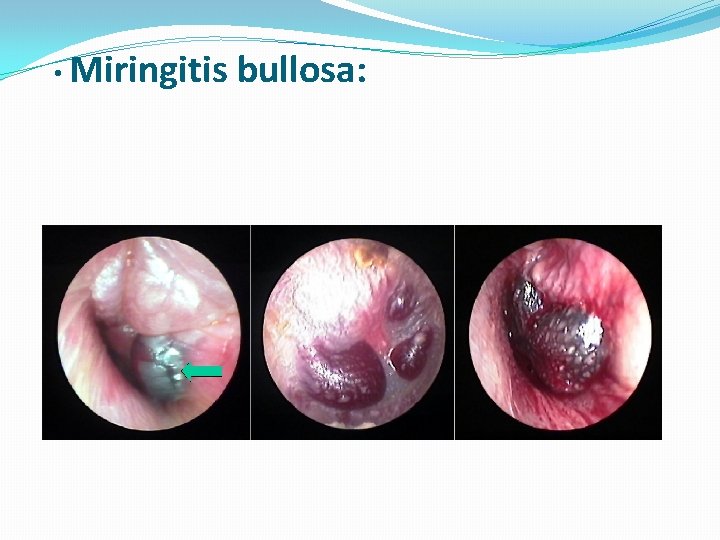  • Miringitis bullosa: 