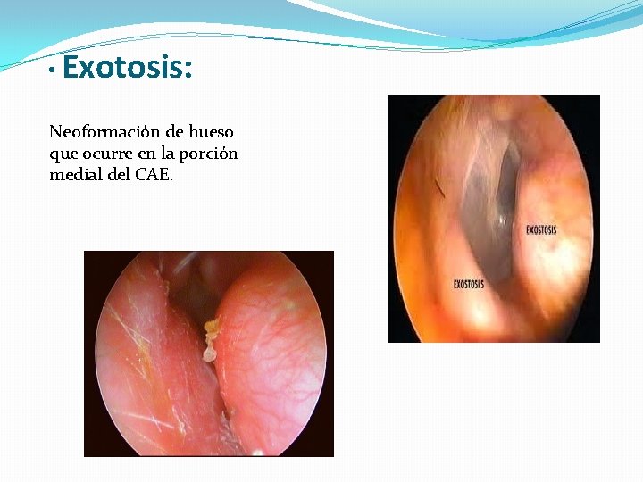  • Exotosis: Neoformación de hueso que ocurre en la porción medial del CAE.