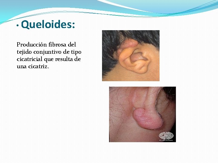  • Queloides: Producción fibrosa del tejido conjuntivo de tipo cicatricial que resulta de