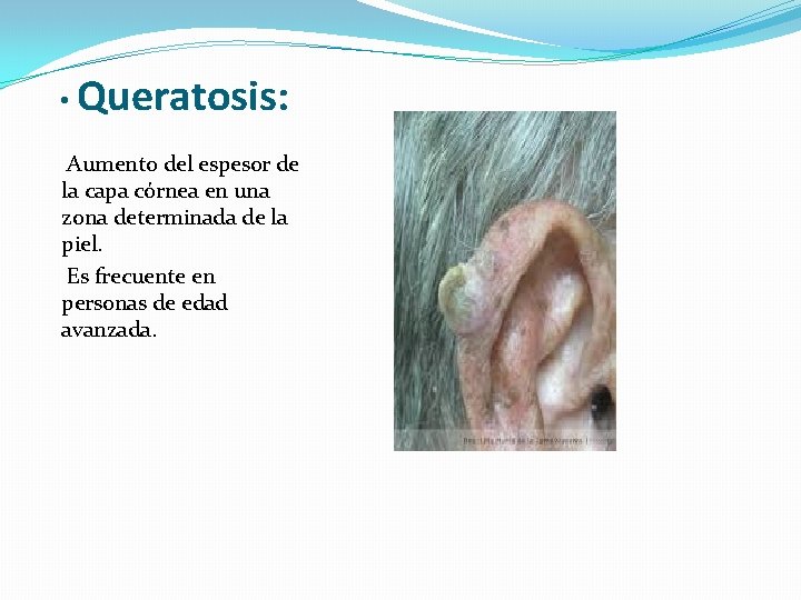  • Queratosis: Aumento del espesor de la capa córnea en una zona determinada