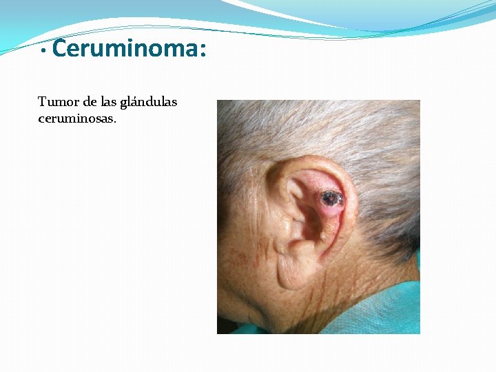  • Ceruminoma: Tumor de las glándulas ceruminosas. 