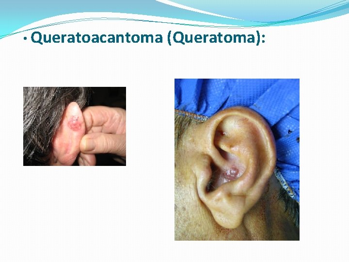  • Queratoacantoma (Queratoma): 