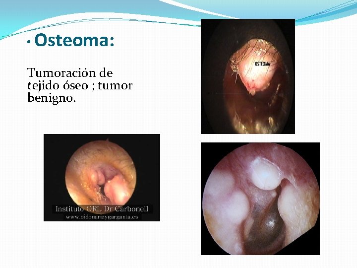  • Osteoma: Tumoración de tejido óseo ; tumor benigno. 