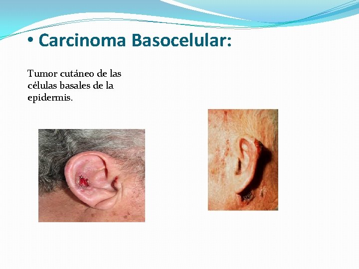  • Carcinoma Basocelular: Tumor cutáneo de las células basales de la epidermis. 