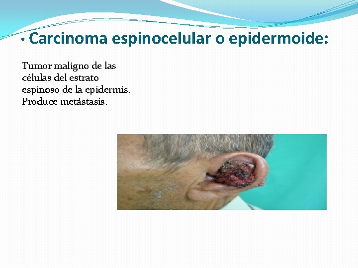  • Carcinoma espinocelular o epidermoide: Tumor maligno de las células del estrato espinoso