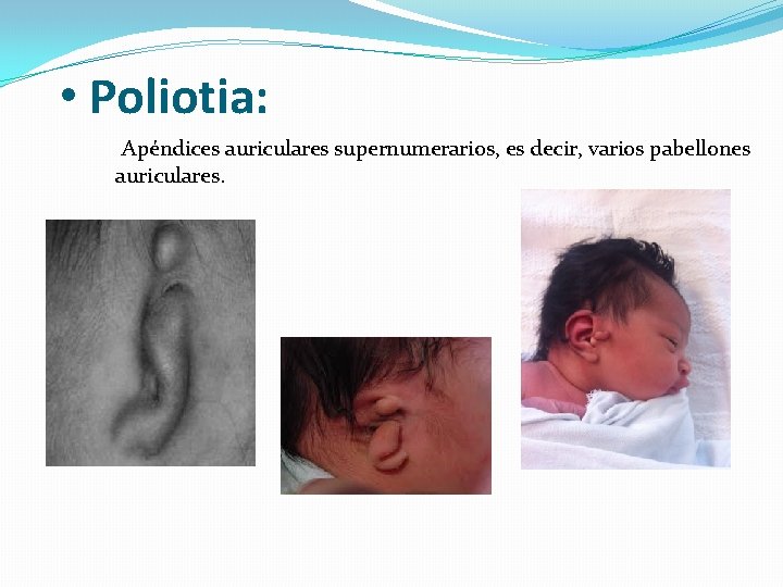  • Poliotia: Apéndices auriculares supernumerarios, es decir, varios pabellones auriculares. 