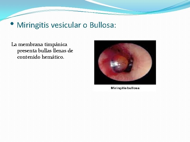  • Miringitis vesicular o Bullosa: La membrana timpánica presenta bullas llenas de contenido