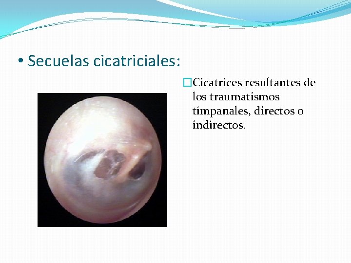  • Secuelas cicatriciales: �Cicatrices resultantes de los traumatismos timpanales, directos o indirectos. 