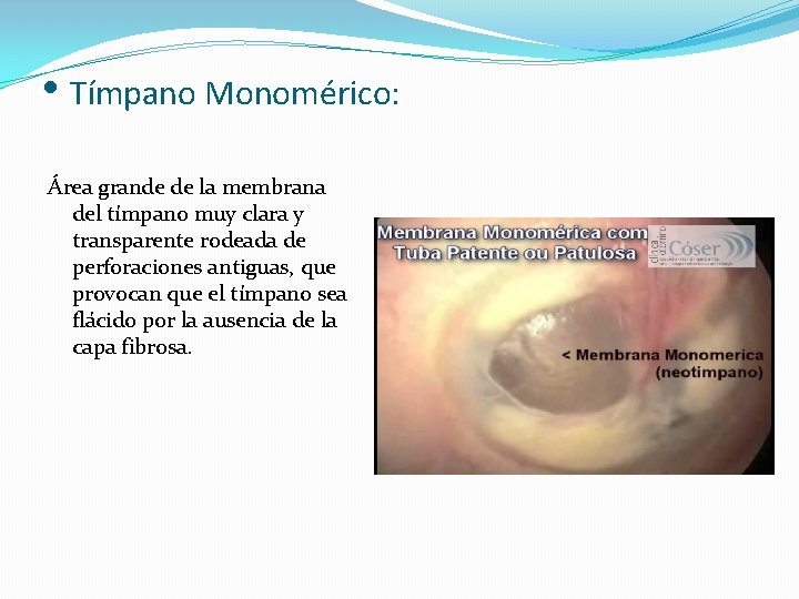  • Tímpano Monomérico: Área grande de la membrana del tímpano muy clara y