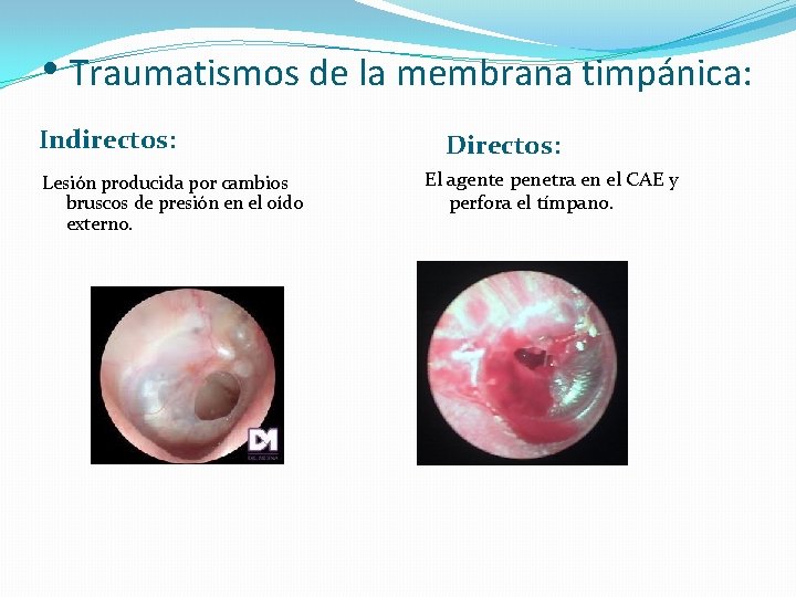  • Traumatismos de la membrana timpánica: Indirectos: Lesión producida por cambios bruscos de