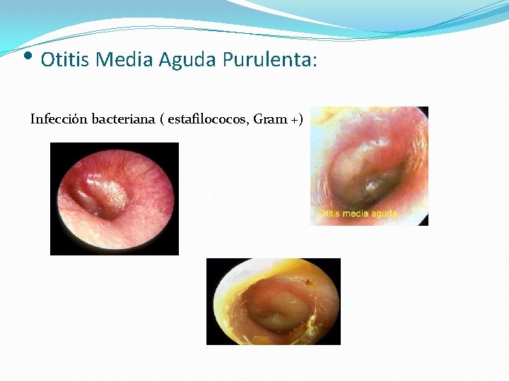 • Otitis Media Aguda Purulenta: Infección bacteriana ( estafilococos, Gram +) 
