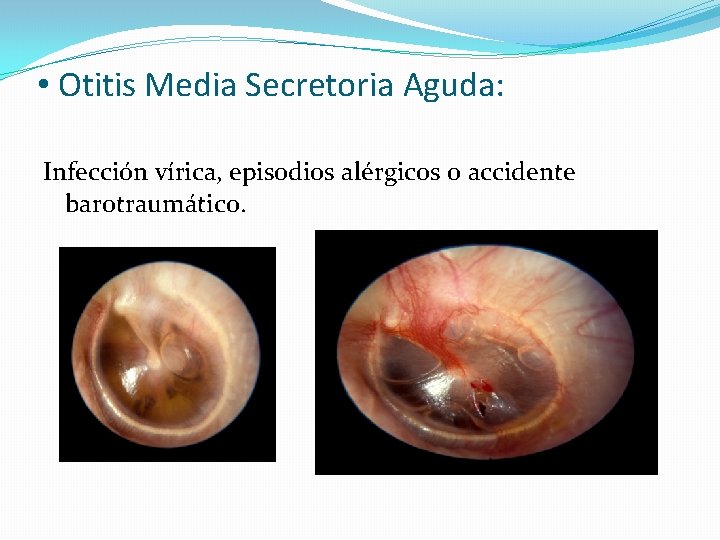  • Otitis Media Secretoria Aguda: Infección vírica, episodios alérgicos o accidente barotraumático. 