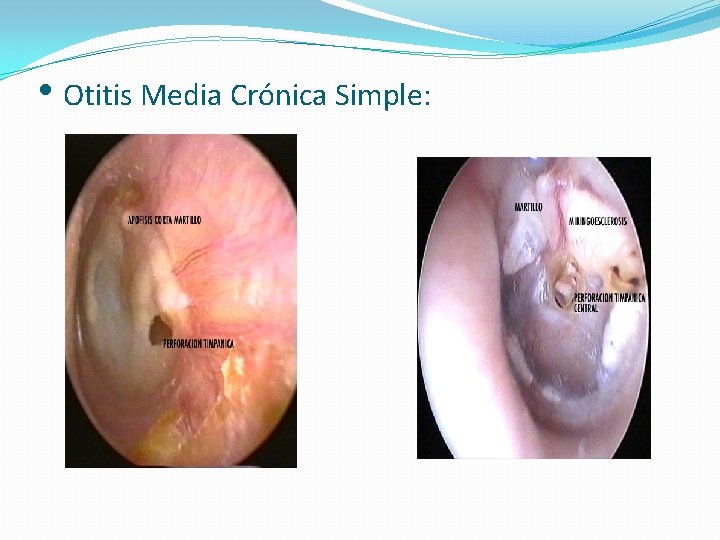  • Otitis Media Crónica Simple: 