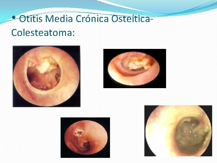  • Otitis Media Crónica Osteítica. Colesteatoma: 