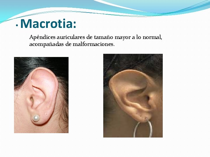  • Macrotia: Apéndices auriculares de tamaño mayor a lo normal, acompañadas de malformaciones.