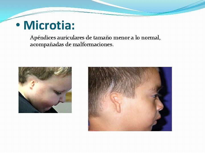  • Microtia: Apéndices auriculares de tamaño menor a lo normal, acompañadas de malformaciones.
