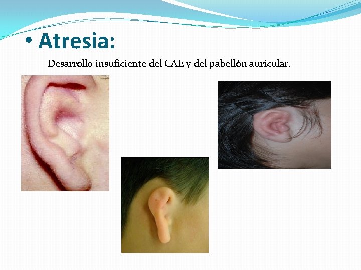  • Atresia: Desarrollo insuficiente del CAE y del pabellón auricular. 