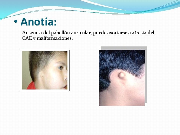  • Anotia: Ausencia del pabellón auricular, puede asociarse a atresia del CAE y