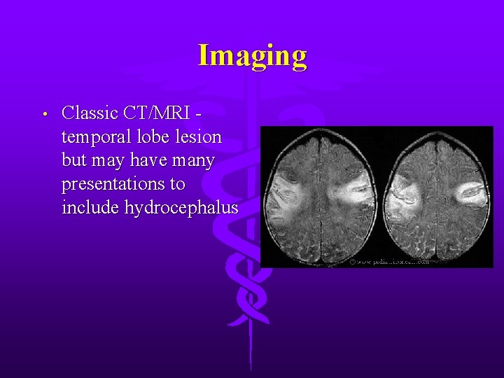 Imaging • Classic CT/MRI temporal lobe lesion but may have many presentations to include