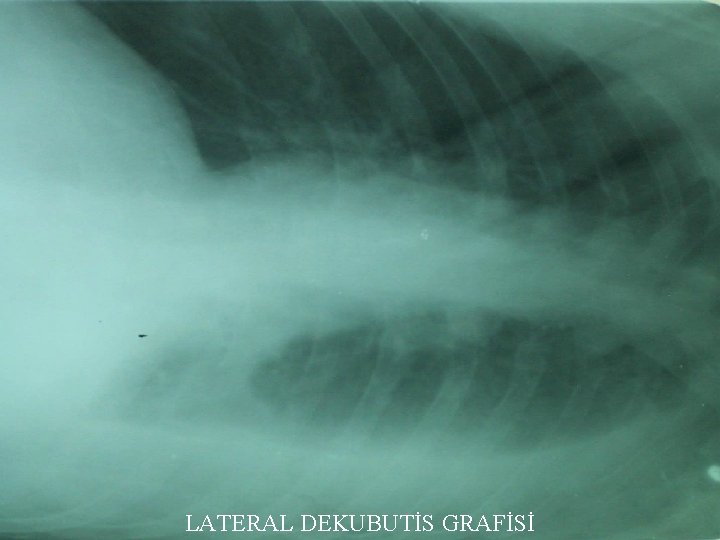 LATERAL DEKUBUTİS GRAFİSİ 