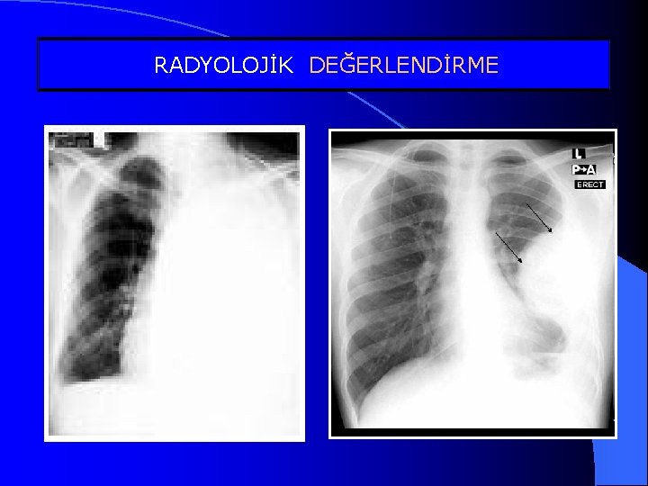 DEĞERLENDİRME Tipik ve. RADYOLOJİK atipik plevral sıvılar 