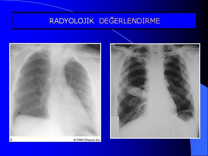 RADYOLOJİK DEĞERLENDİRME Atipik plevral sıvılar 