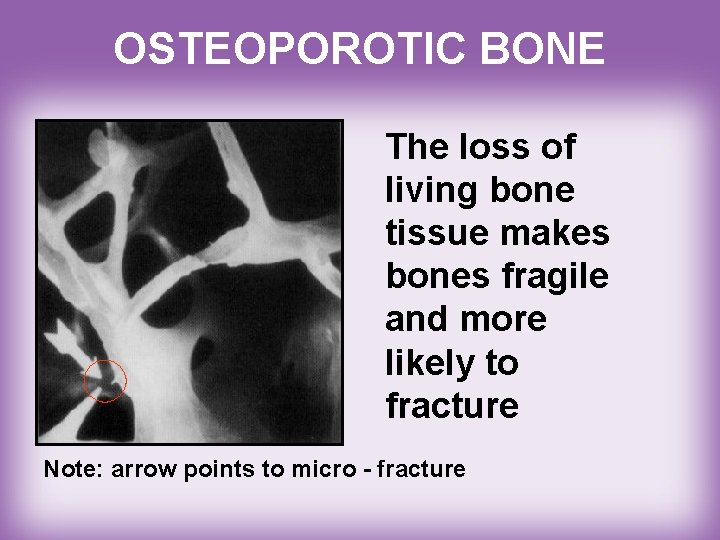 OSTEOPOROTIC BONE The loss of living bone tissue makes bones fragile and more likely