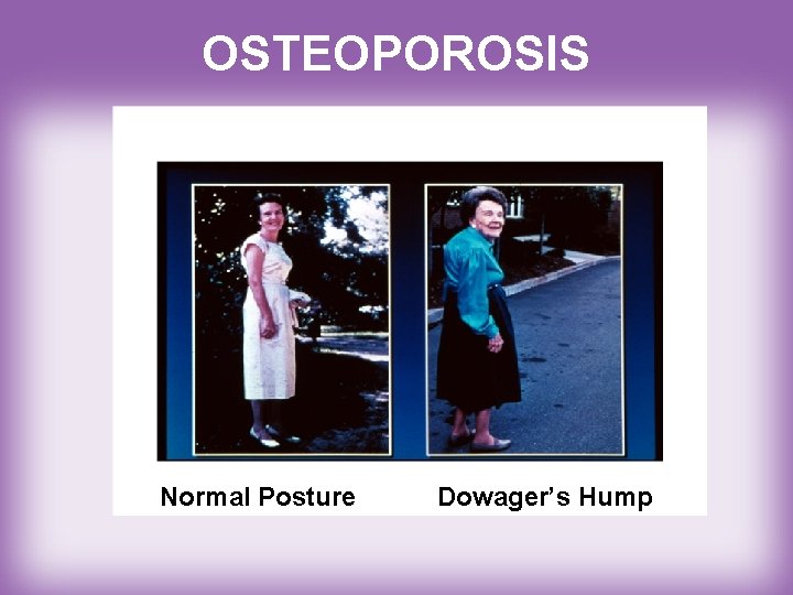 OSTEOPOROSIS Normal Posture Dowager’s Hump 