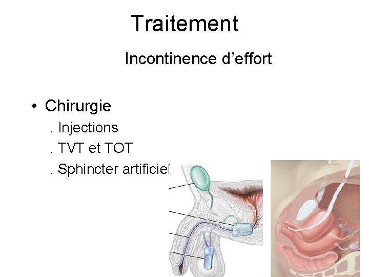 Traitement Incontinence d’effort • Chirurgie. Injections . TVT et TOT. Sphincter artificiel 