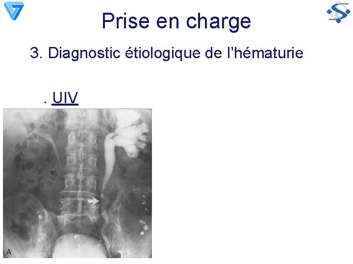 Prise en charge 3. Diagnostic étiologique de l’hématurie. UIV 