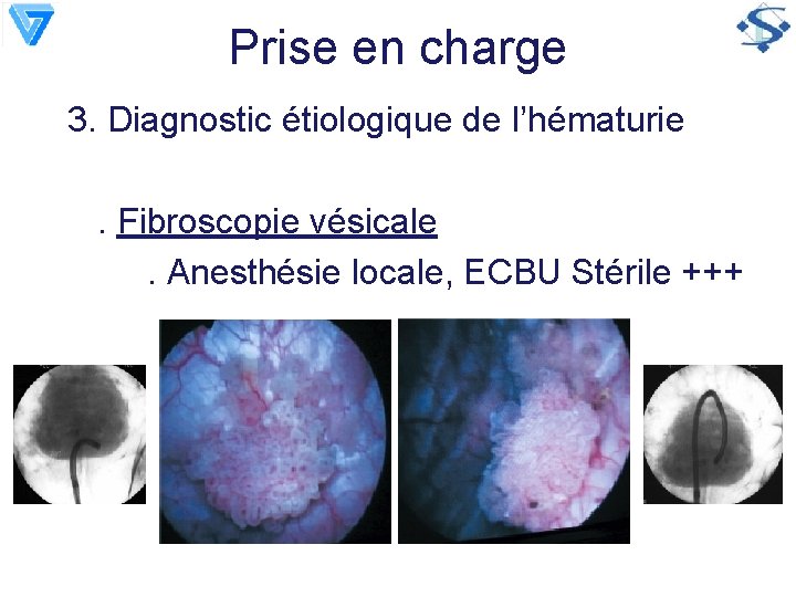 Prise en charge 3. Diagnostic étiologique de l’hématurie. Fibroscopie vésicale. Anesthésie locale, ECBU Stérile