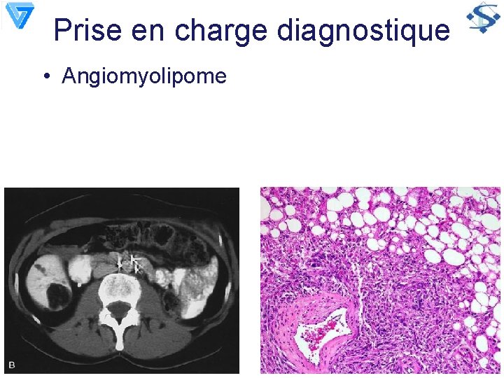 Prise en charge diagnostique • Angiomyolipome 