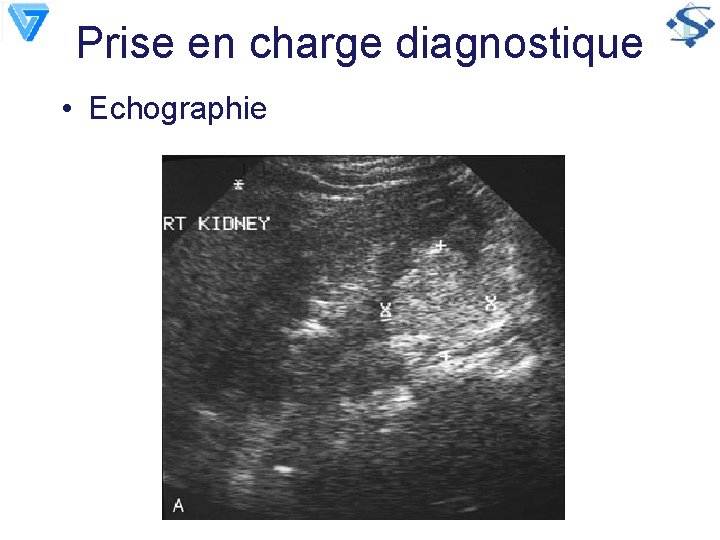 Prise en charge diagnostique • Echographie 