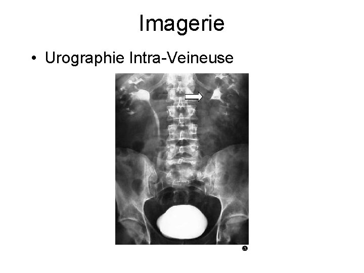 Imagerie • Urographie Intra-Veineuse 
