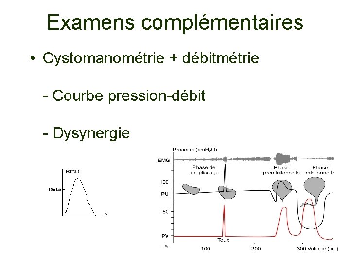 Examens complémentaires • Cystomanométrie + débitmétrie - Courbe pression-débit - Dysynergie 