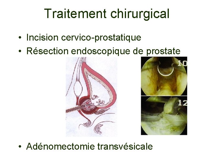 Traitement chirurgical • Incision cervico-prostatique • Résection endoscopique de prostate • Adénomectomie transvésicale 