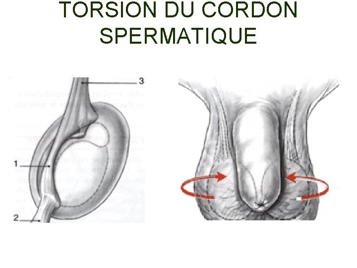 TORSION DU CORDON SPERMATIQUE 
