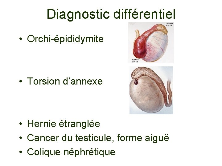 Diagnostic différentiel • Orchi-épididymite • Torsion d’annexe • Hernie étranglée • Cancer du testicule,