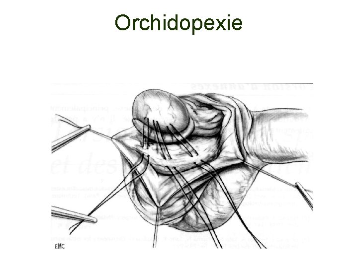 Orchidopexie 